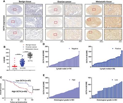 OCT4 induces EMT and promotes ovarian cancer progression by regulating the PI3K/AKT/mTOR pathway